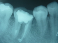 endo1-2