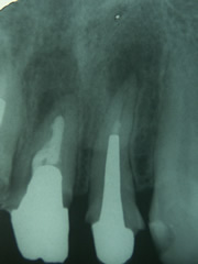 endo11-1