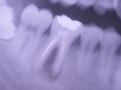 endo12-1