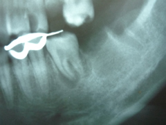 endo17-2