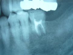endo17-3