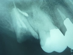 endo7-2