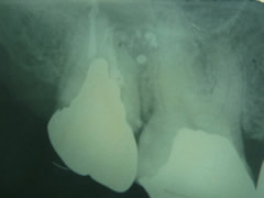 endo7-3
