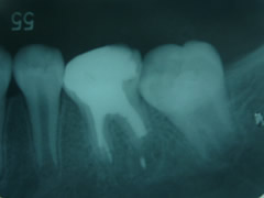endo8-2