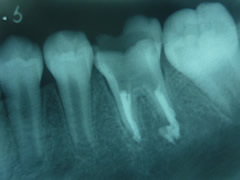 endo8-3