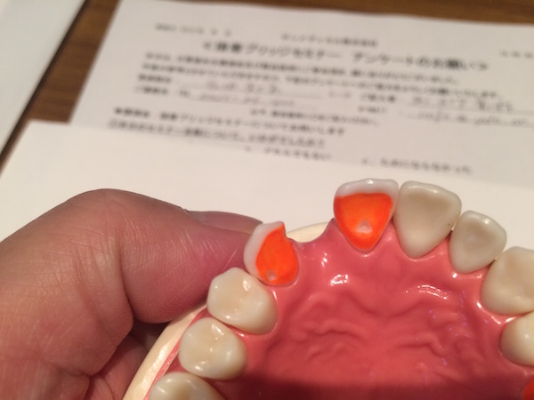 接着性ブリッジ